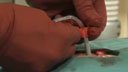 Gastrostomy insertion using SafeTpexy kit