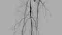 Subintimal angioplasty