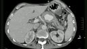 Thrombin injection splenic artery pseudoaneurysm